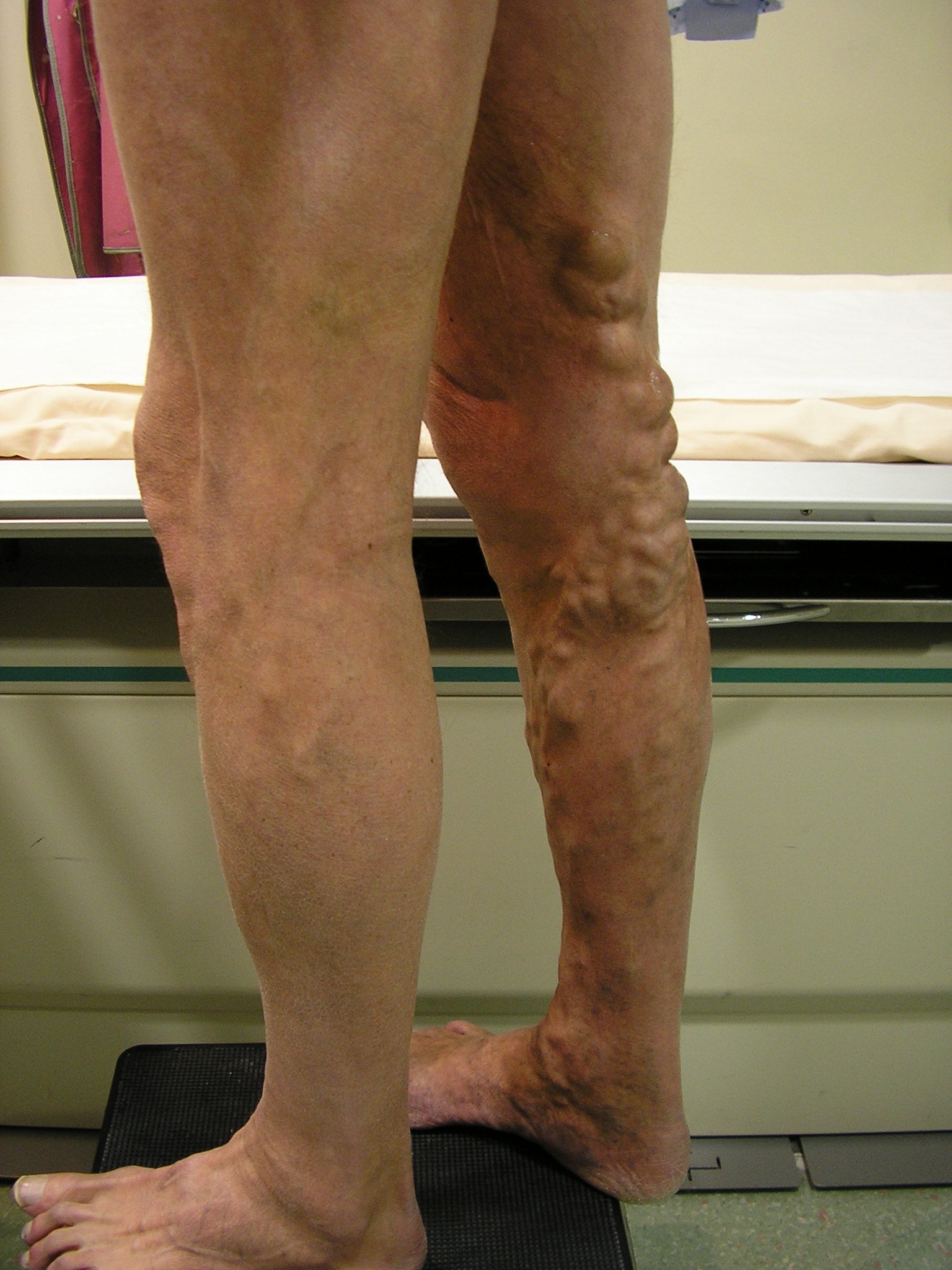 varicose-veins-bsir